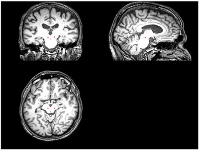 Galvanic Vestibular Stimulation (GVS) Augments Deficient Pedunculopontine Nucleus (PPN) Connectivity in Mild Parkinson's Disease: fMRI Effects of Different Stimuli